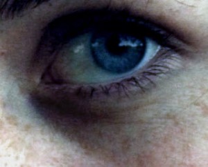 Dark Eye Circle