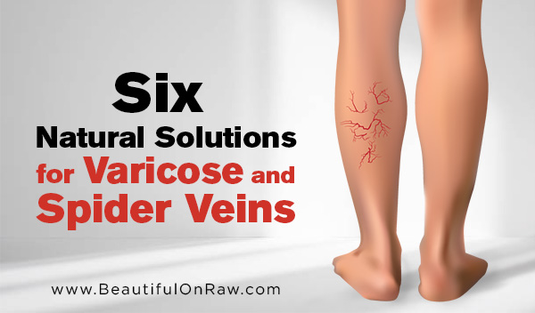 Six Natural Solutions for Varicose and Spider Veins