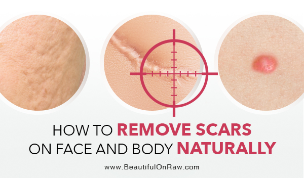 How To Remove Scars On Face And Body Naturally