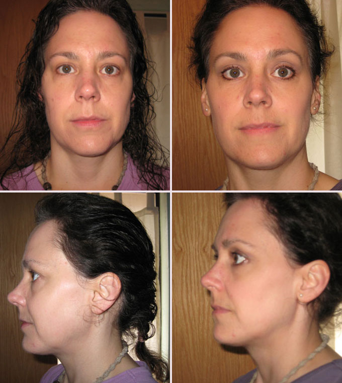 face slimming exercises before and after before and after